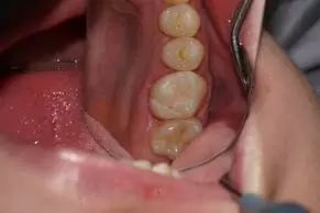Композитная реставрация (8 случай)