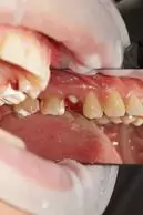 Керамические коронки