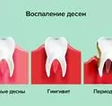 Лікування гінгівіту в Харкові