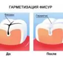 Герметизація фісур у дітей