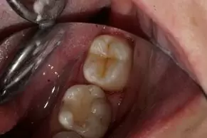 Композитная реставрация (4 случай)